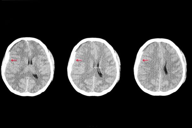CT Scan Images of Traumatic Brain Injury